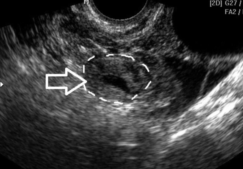 На узи видно внематочную. Внематочная беременность в трубе УЗИ. Маточная беременность УЗИ. Внематочная беременность плодное яйцо. Внематочная Трубная беременность УЗИ.