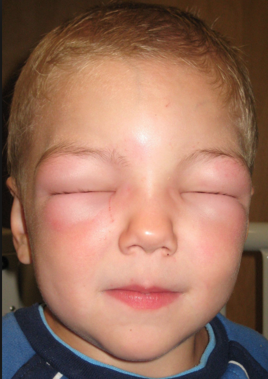 Генерализованные аллергические синдромы у детей thumbnail
